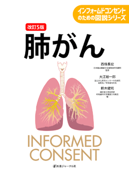 インフォームドコンセントのための図説シリーズ 改訂5版　肺がん